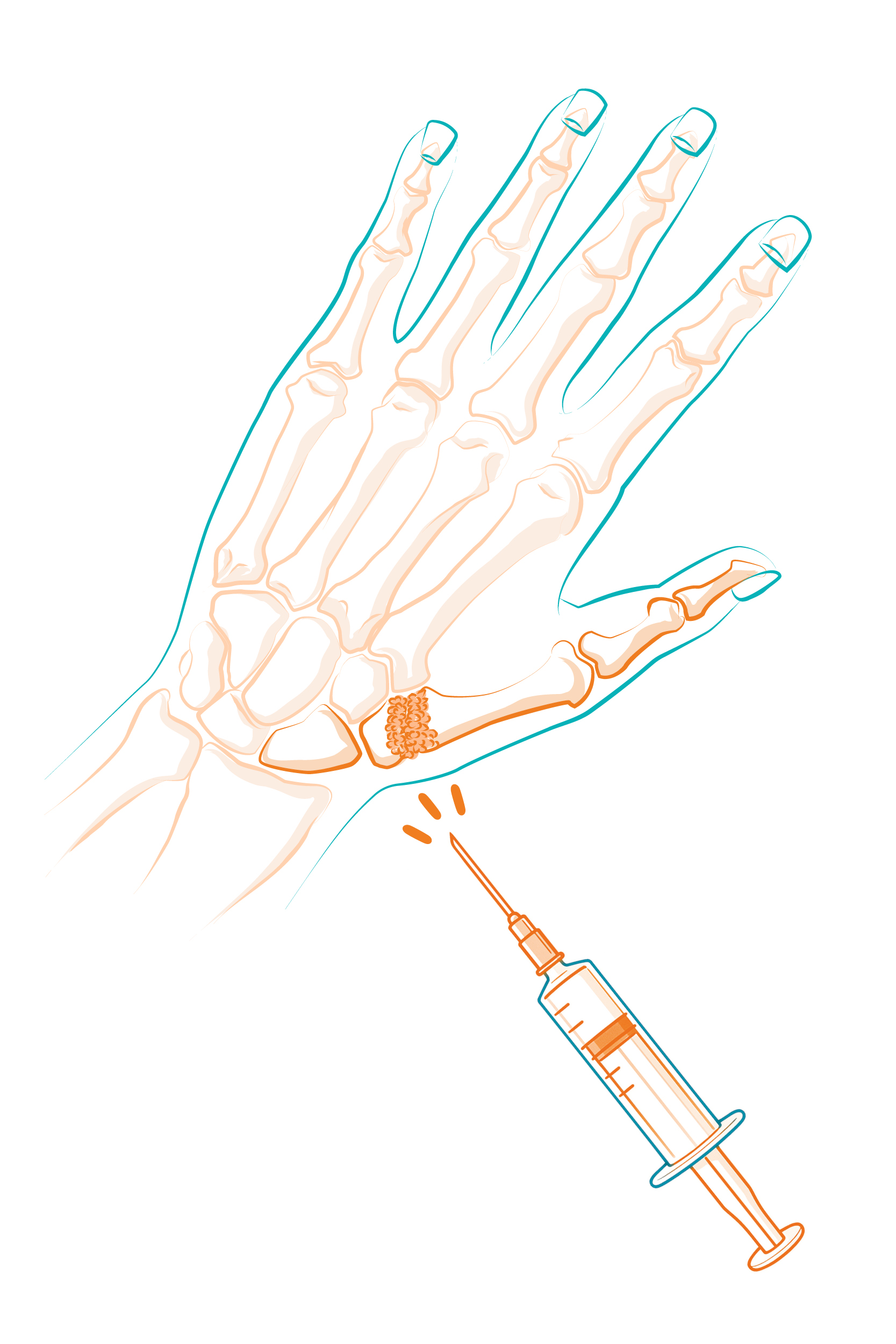 Illustration d'une main avec injection médicale.