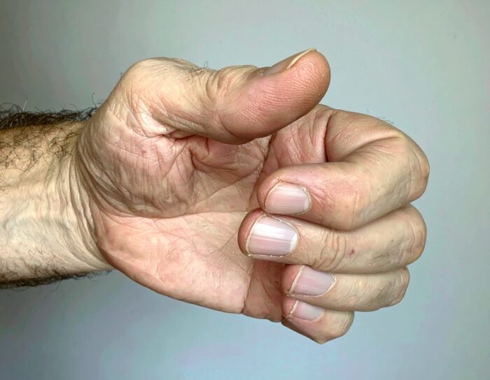 de hand van een 45-jarige blanke man met een door artrose vervormde duim